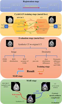 A novel approach for eliminating metal artifacts based on MVCBCT and CycleGAN